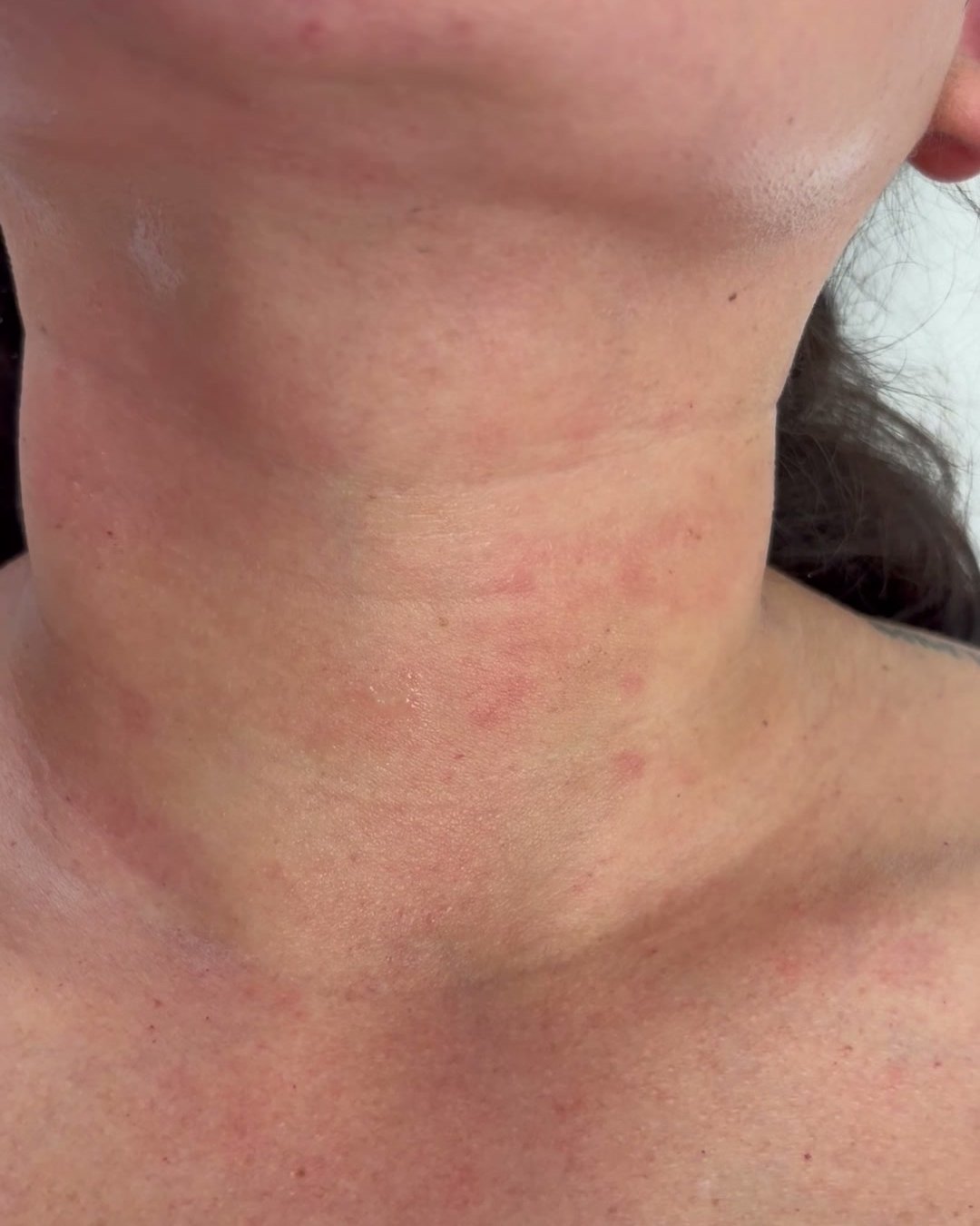 Neck and upper chest with patchy redness shortly after a skin-tightening treatment